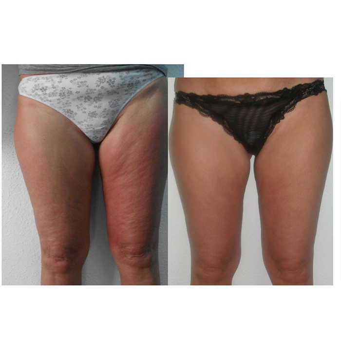 antes y despues 1