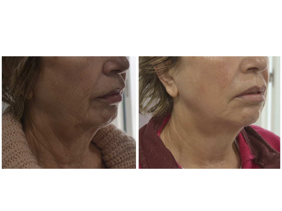 antes y despues 12