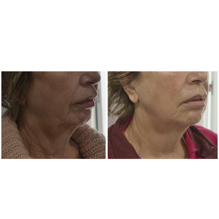 antes y despues 20